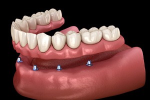 Illustration of implant denture for lower arch against dark background