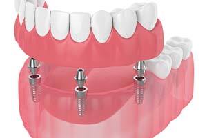 3D illustration of an implant denture