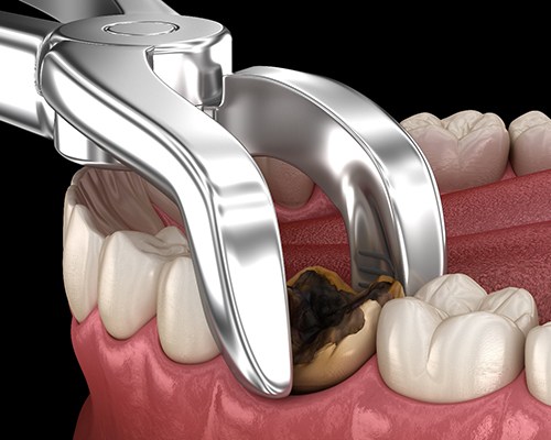 illustration of decay causing tooth extractions in Bedford