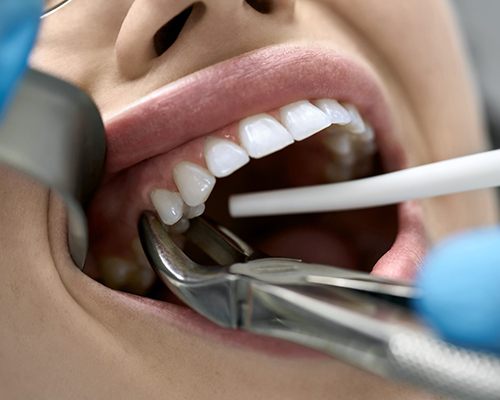 procedure for tooth extractions in Bedford