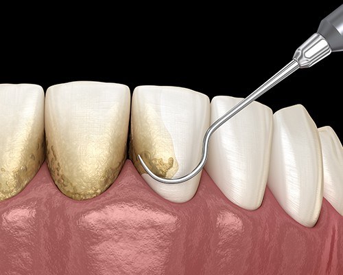 Animated smile during scaling and root planing periodontal therapy