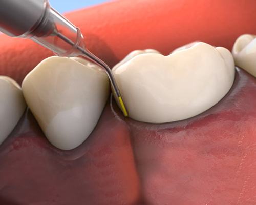 Anitibiotic periodontal therapy