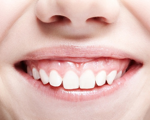 Woman smiling with a gummy smile