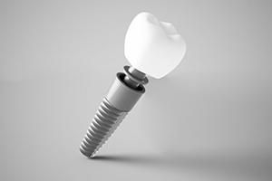 dental implant post with abutment and crown
