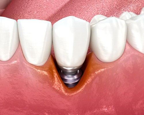 Illustration showing gum recession around a dental implant