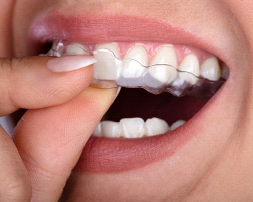 close up of someone putting aligner in their mouth