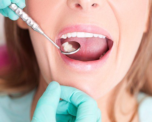 Dentist checking smile after fluoride treatment