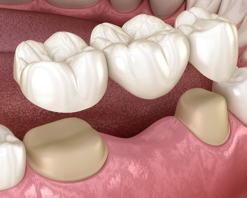 Animated dental bridge placement