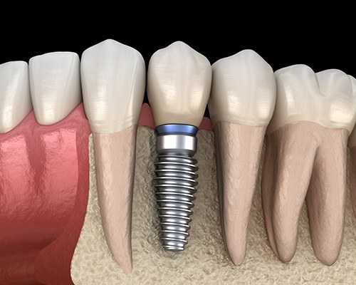 Animated dental implant supported dental crown