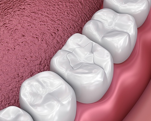 Animated tooth with seamless filling restoration