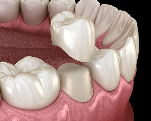 Animated dental crown placement