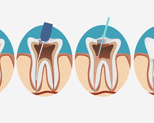 illustration for root canal therapy in Bedford 