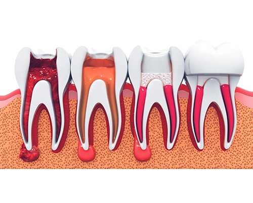 Animated tooth at various stages of root canal process