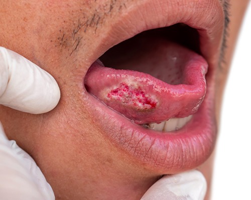 Man with oral cancer on his tongue