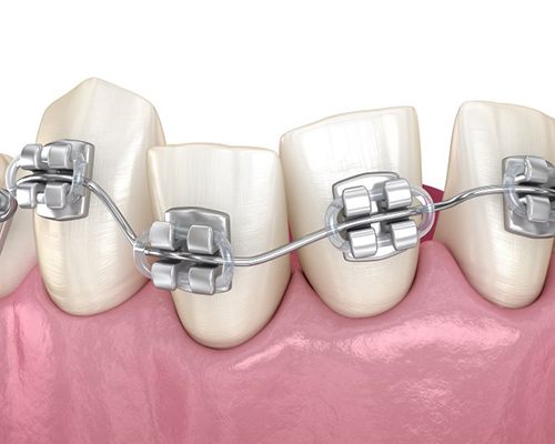 Illustration of braces on misaligned teeth