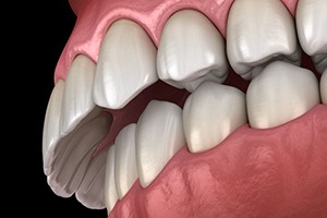 Illustration of overbite against dark background