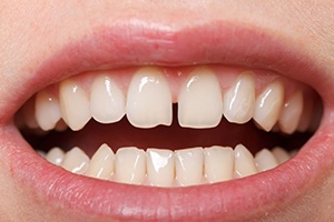 Woman’s smile with a gap between the front teeth