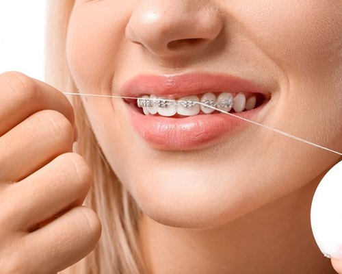 Woman with braces flossing her teeth