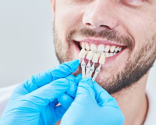 man getting veneers placed