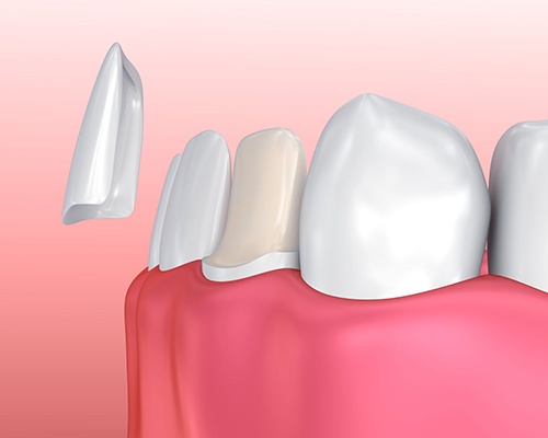 diagram of veneer being placed over bottom tooth 