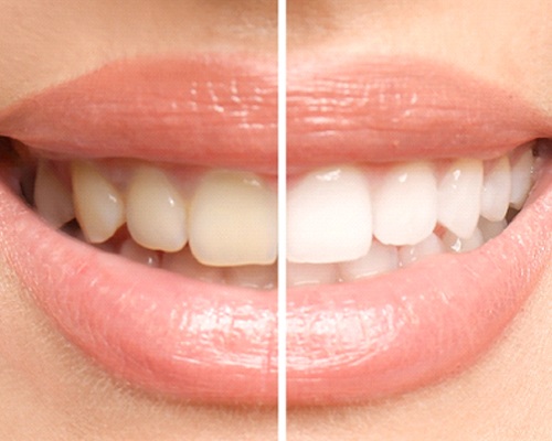 Before and after picture of teeth whitening in Bedford, TX