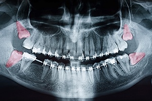 an X-ray showing impacted wisdom teeth