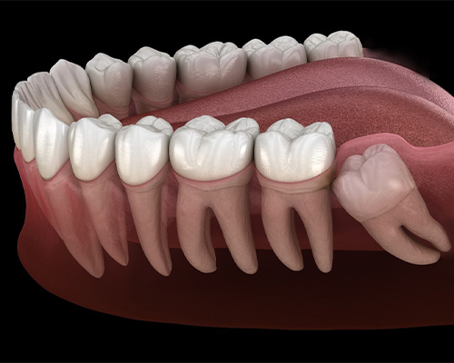 Illistration of an impacted wisdom tooth in Bedford, TX