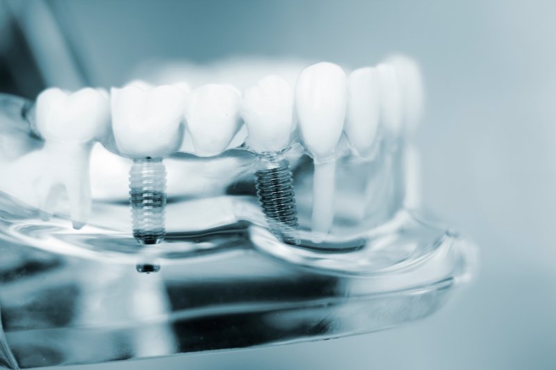 A close-up of dental implants  in a mock jaw