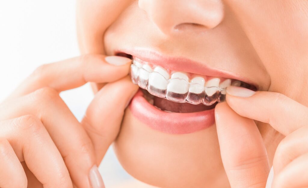 Nose-to-chin closeup of woman putting Invisalign over upper arch