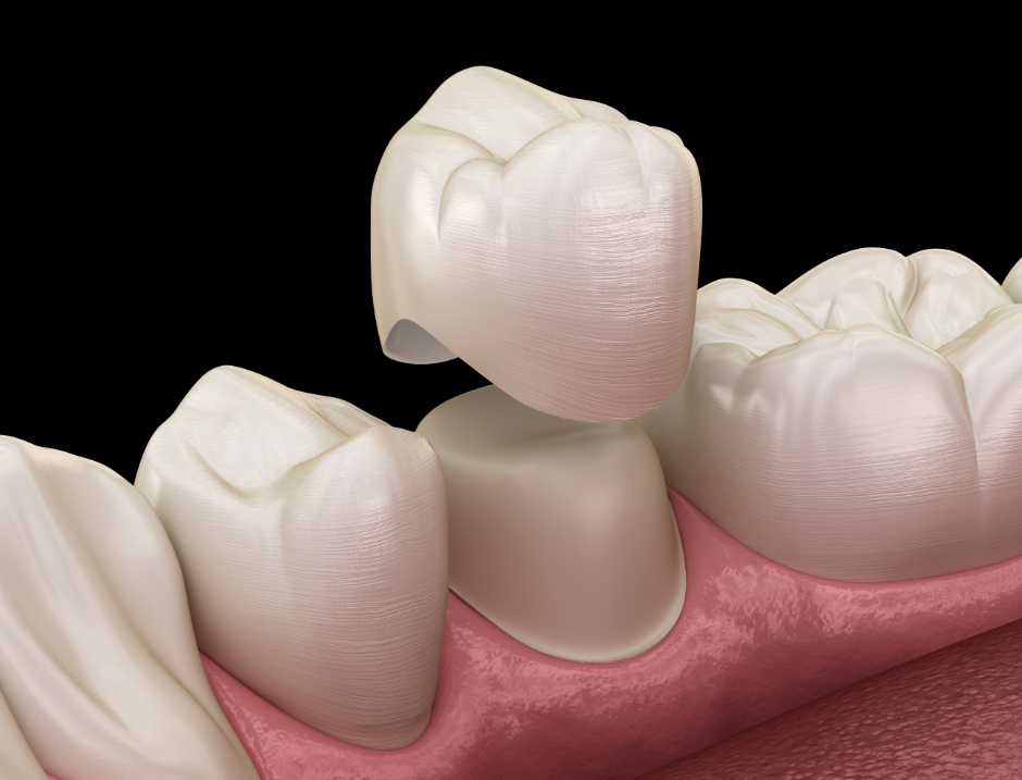 3D image of a dental crown