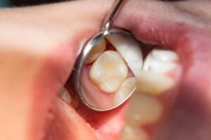 Dental mirror tool giving close-up of tooth.
