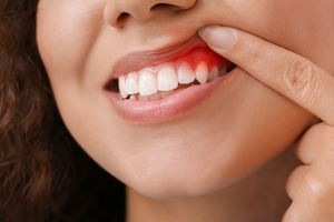 Woman pulling up lip to show inflamed gums