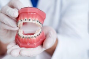 Plastic mold of mouth with braces on the teeth.