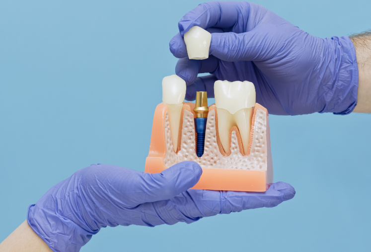 Hands holding model dental implant